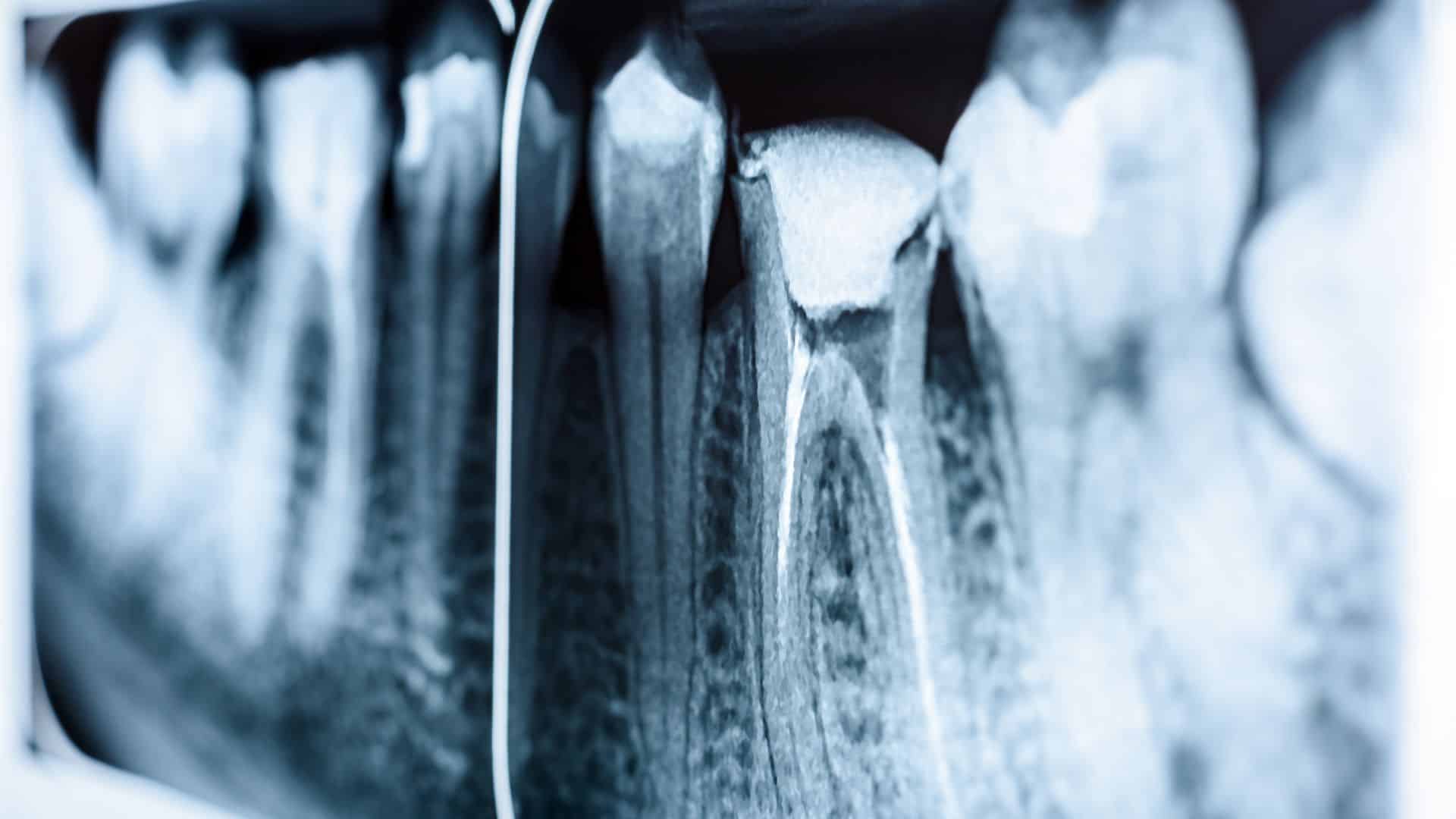Root Canal Retreatment